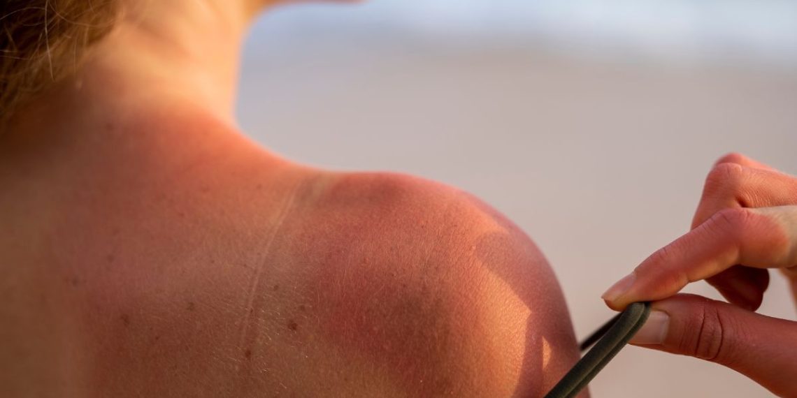 Qué hacer ante las quemaduras solares: consejos prácticos para aliviar y prevenir daños en la piel 1 Rayos UV