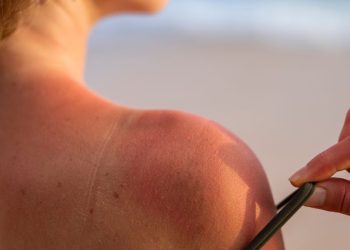 Qué hacer ante las quemaduras solares: consejos prácticos para aliviar y prevenir daños en la piel 12 Qué hacer ante las quemaduras solares: consejos prácticos para aliviar y prevenir daños en la piel